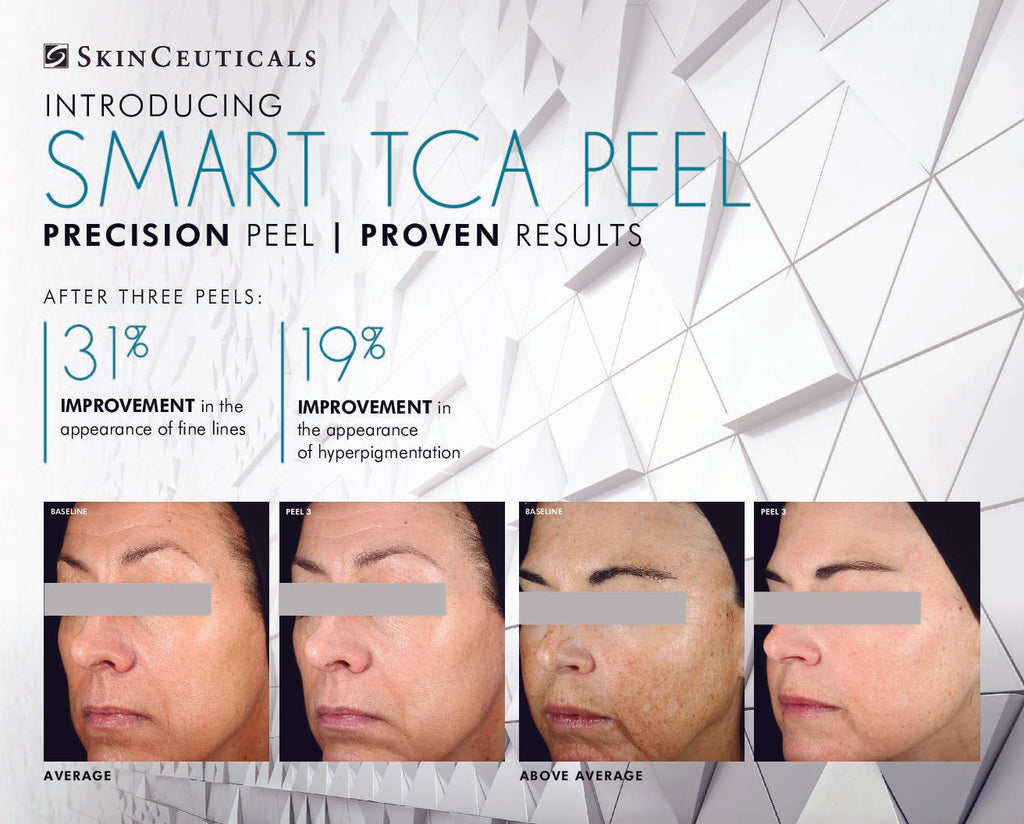 Smart TCA Peel