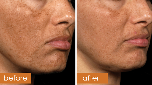 Fraxel® DUAL 1927 / 1550 Laser Resurfacing Treatment